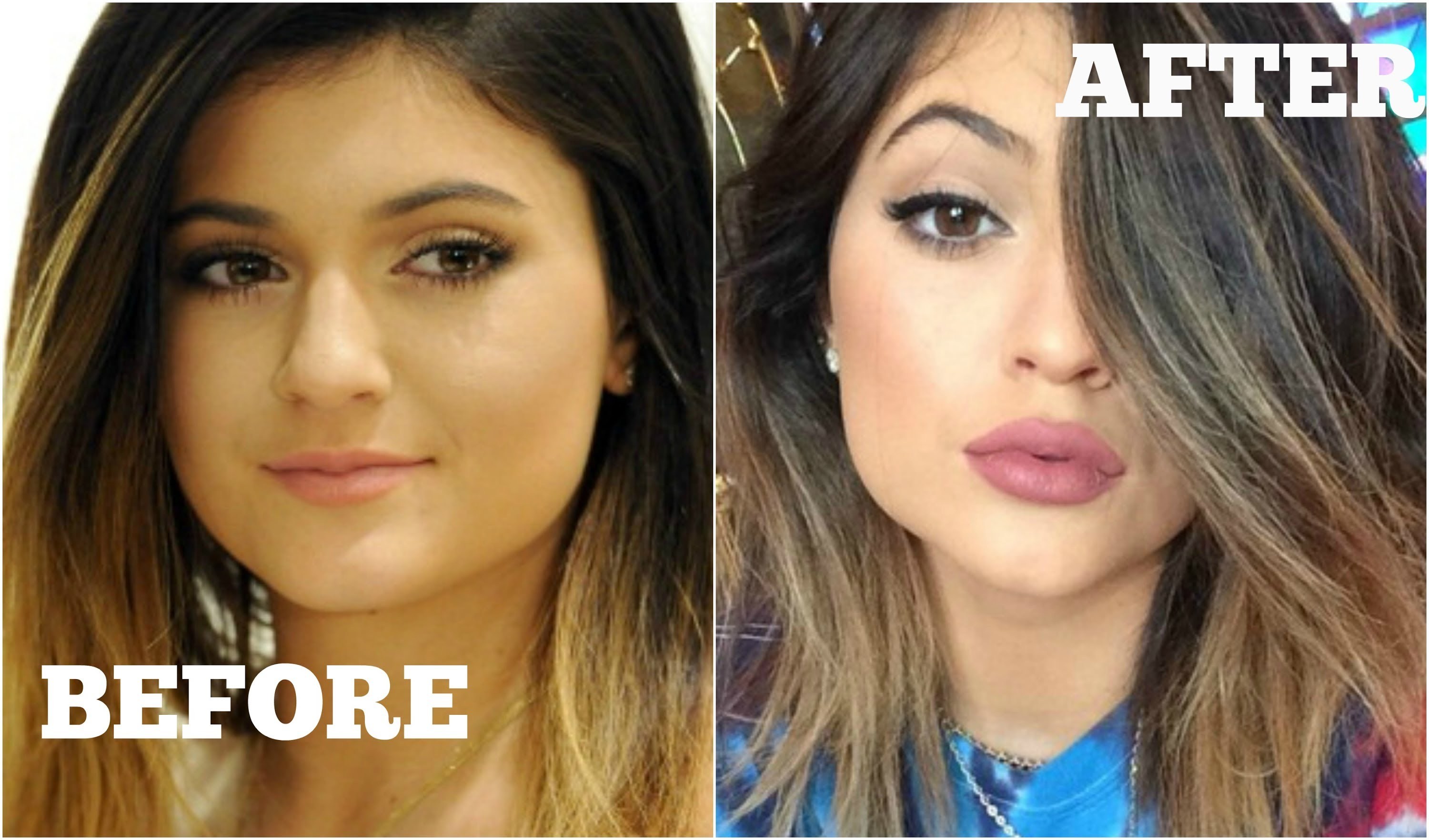 kylie jenner lips before after